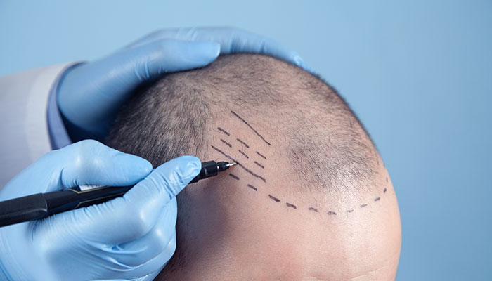 All You Need To Know About Hair Transplantation